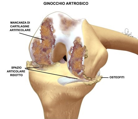 Artrosi del ginocchio, Dr Emanuele Rodà